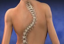 Η σκολίωση σε παιδιά & εφήβους Η σκολίωση σε παιδιά & εφήβους